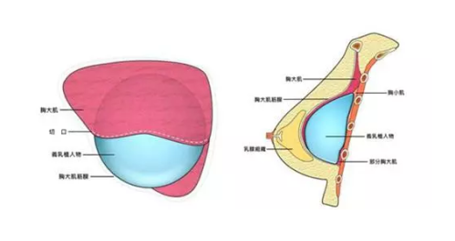 八大处刘春军乳房下垂矫正怎么样？副主任主刀，悬吊固定技术稳，口碑佳